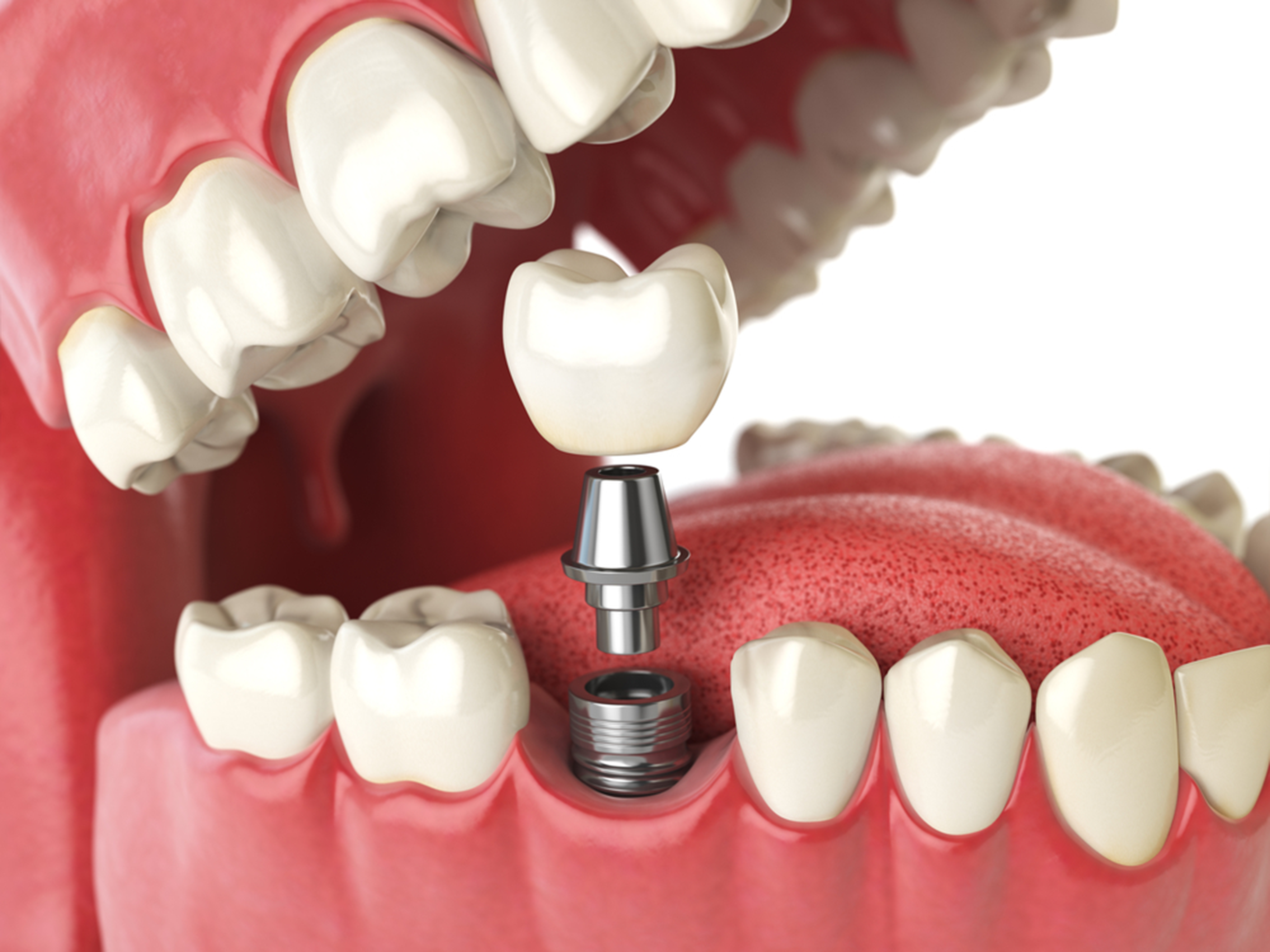interesting dental implant facts