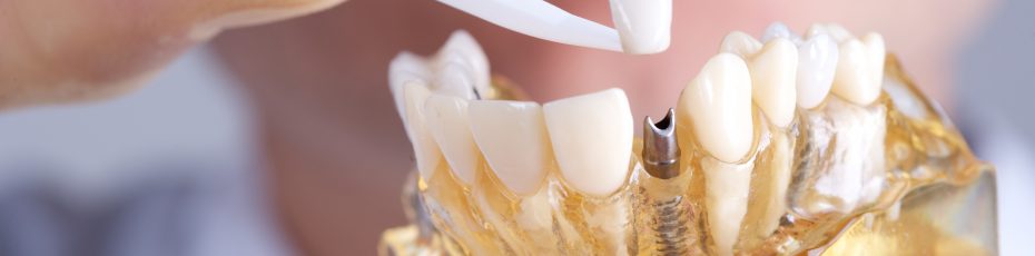 5 after care tips for your dental implants