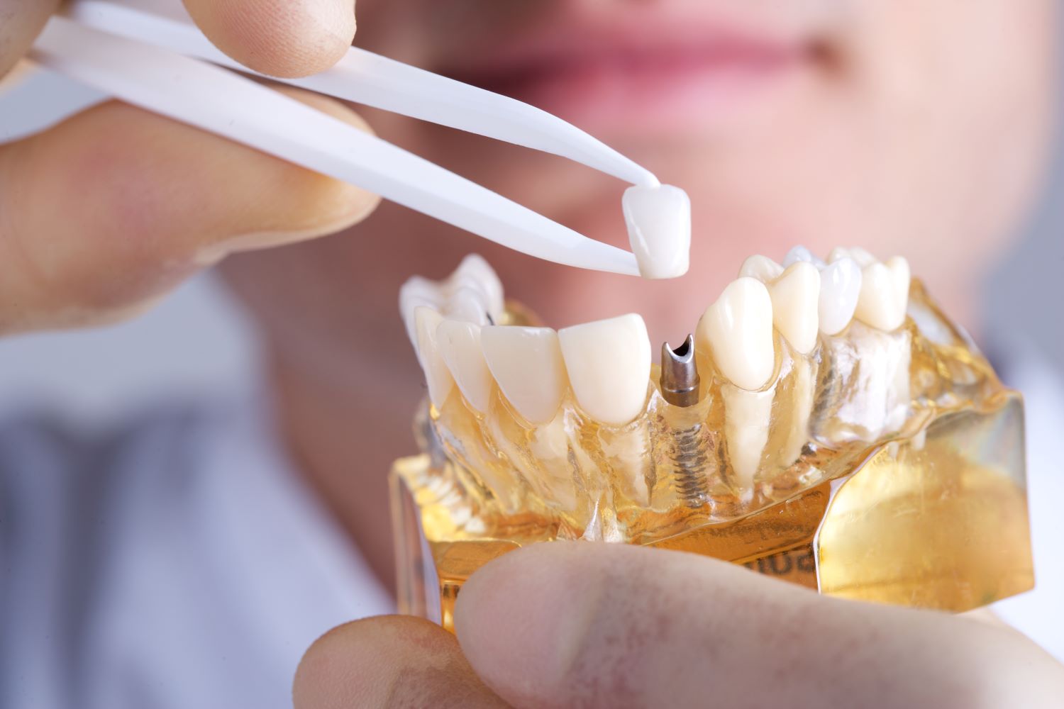 4 things to know about TeethXpress dental implants