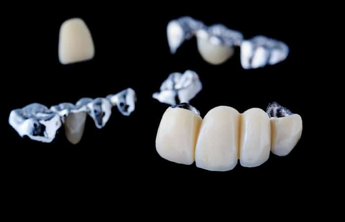 dental bridges in Forest Lake