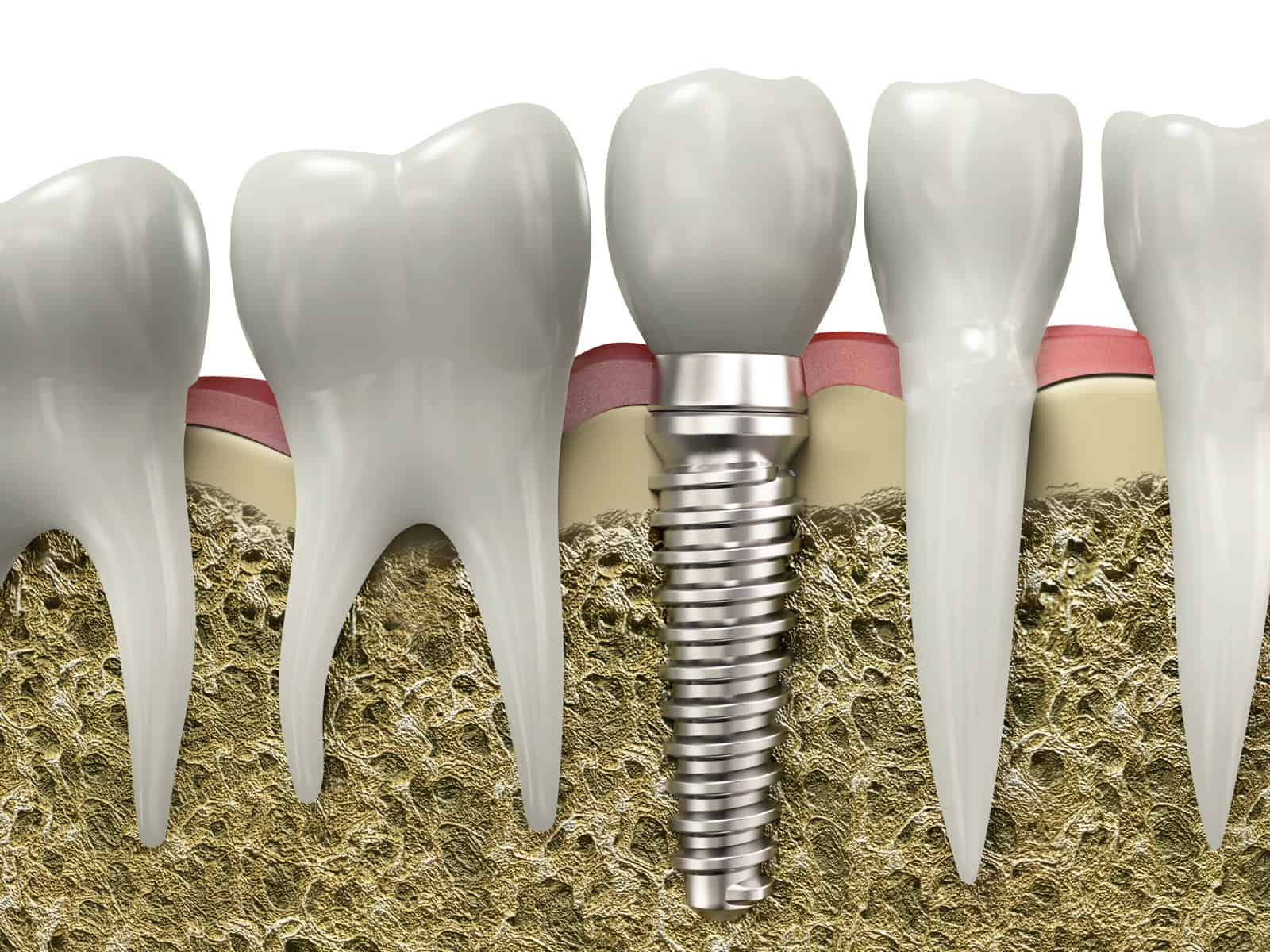 dental implants Forest Lake