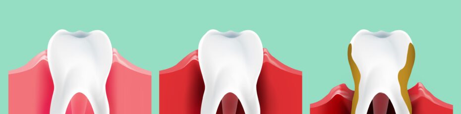 understanding the different stages of gum disease