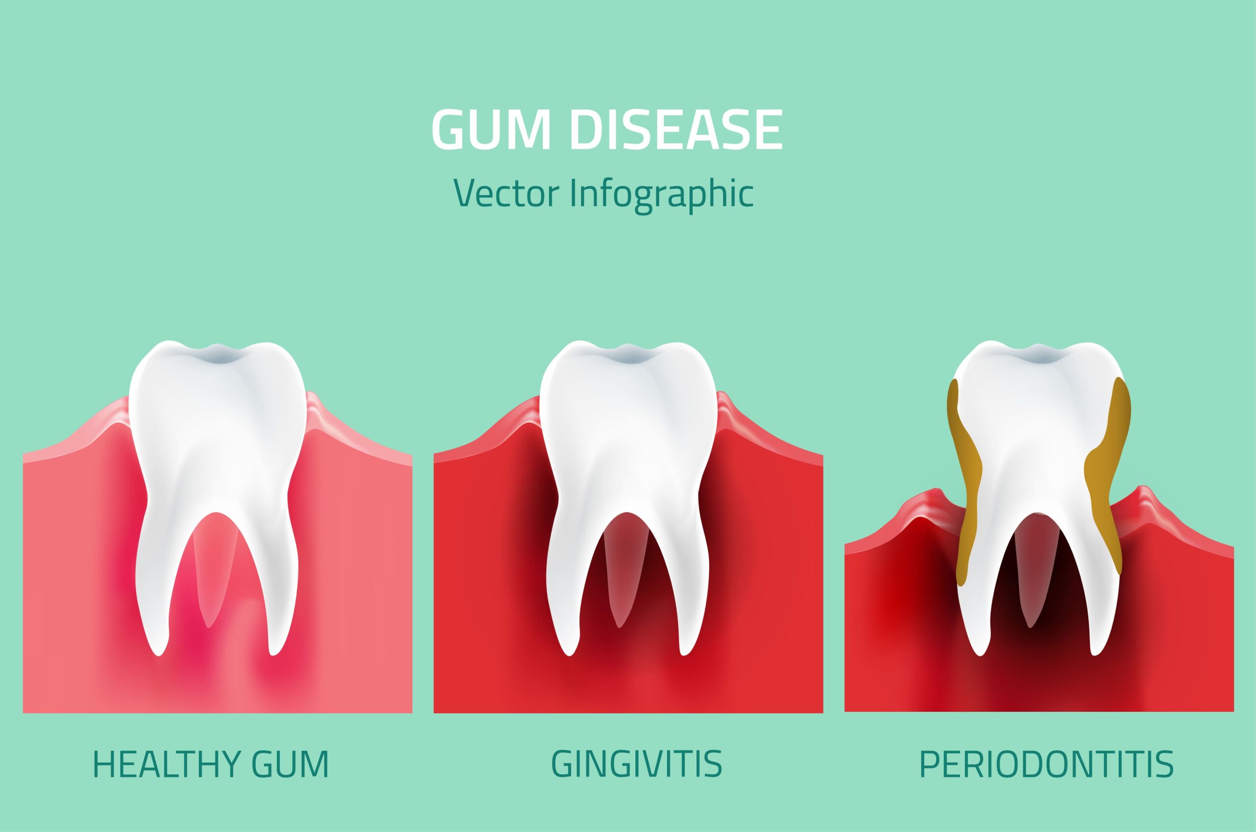understanding the different stages of gum disease