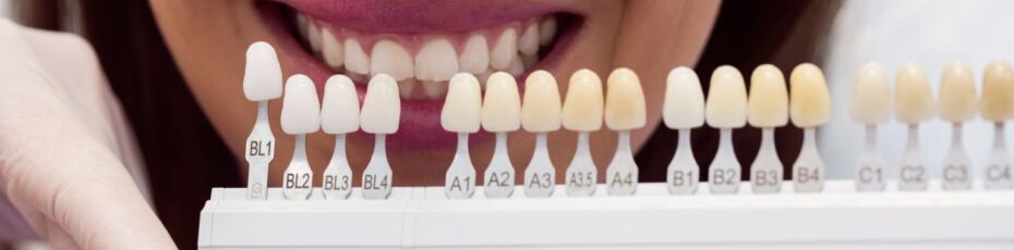 How Porcelain Veneers Help Fix Cracked, Chipped, or Stained Teeth