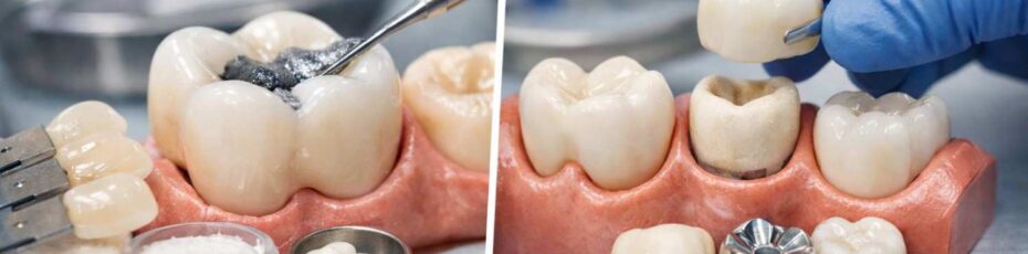 Do I Need a Filling or a Crown? Signs & Dental Professional Advice