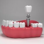 Dental implant for tooth loss after infection