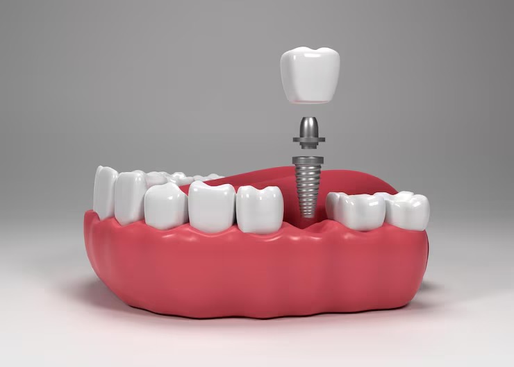 Dental implant for tooth loss after infection