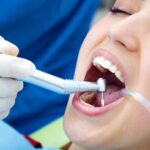 Frequent cavities heres how dental sealants can help